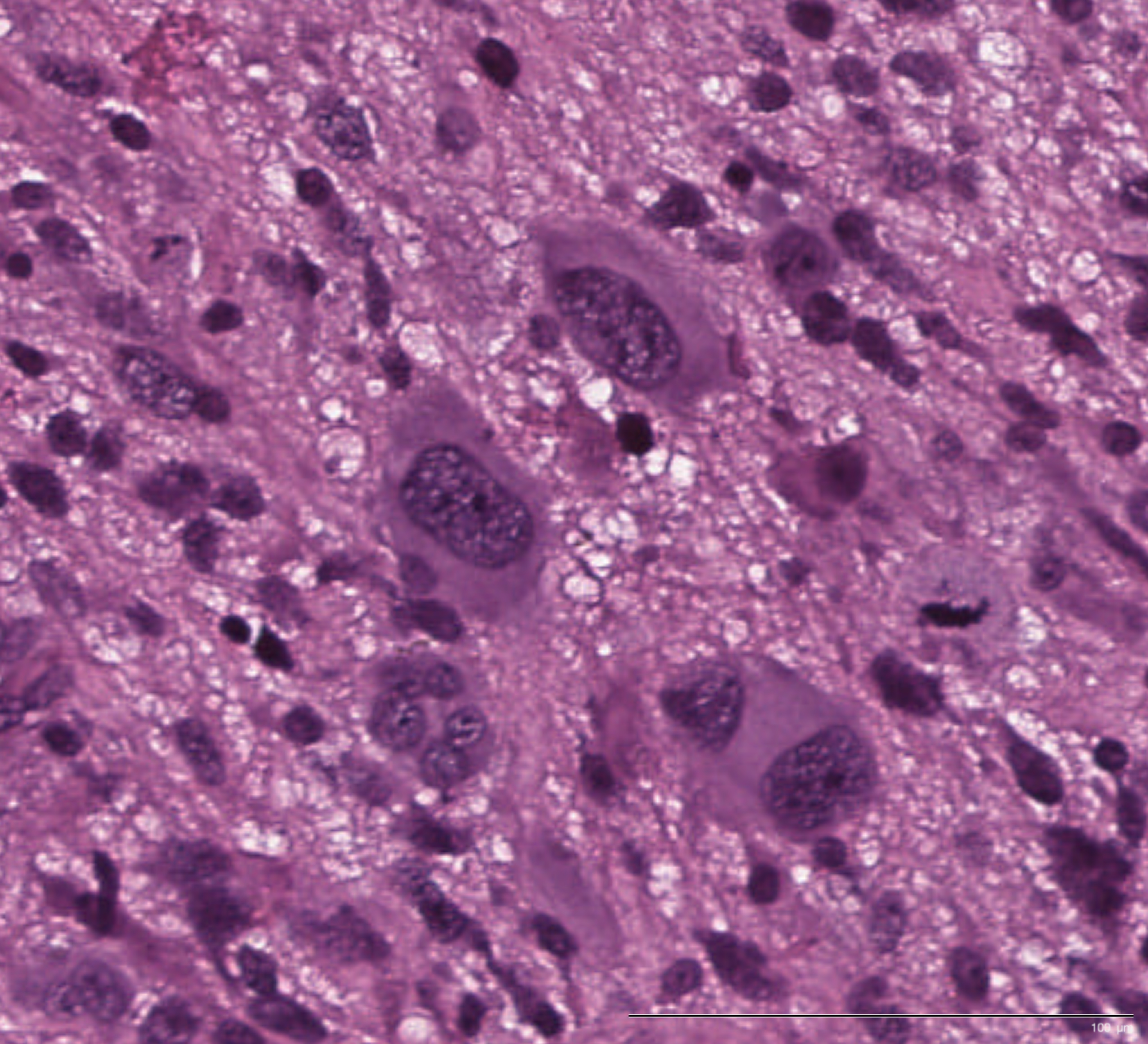 Hematoxylin and eosin stained brain tumor tissue